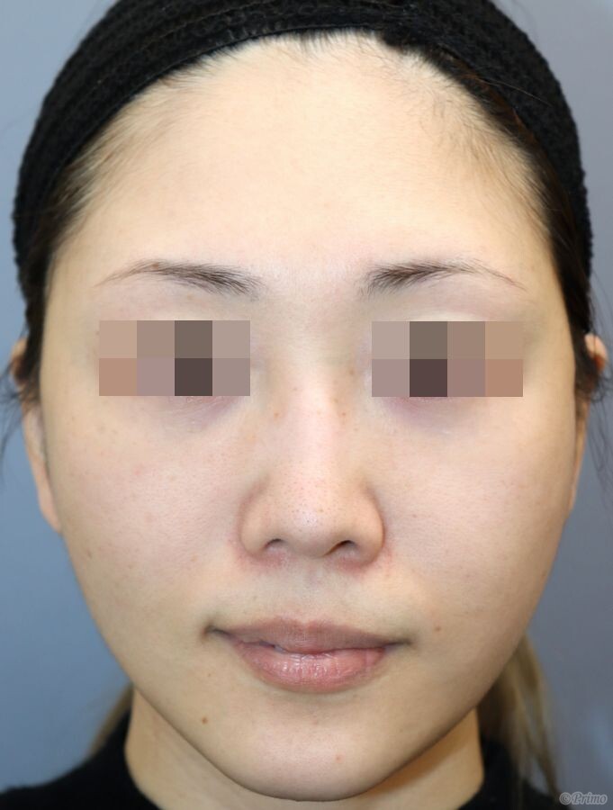 L 頬部フェイスリフト 頬顎脂肪吸引 症例経過写真 プリモ麻布十番クリニック