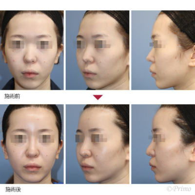 G 前額プロテーゼ＋鼻中隔延長術＋隆鼻術＋眉間プロテーゼ 症例経過写真