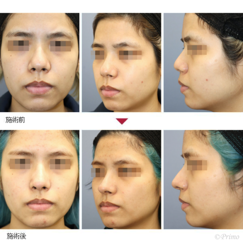 鼻整形 鼻の美容整形や鼻形成なら プリモ麻布十番クリニック