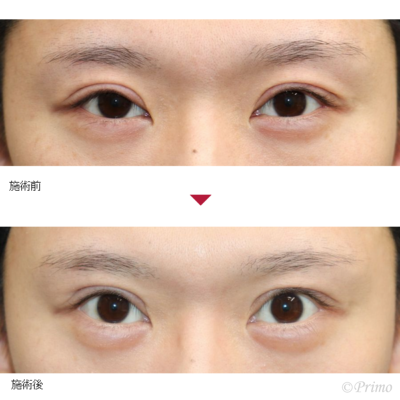 BK 二重修正術＋右目眼瞼下垂修正術 症例経過写真