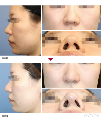 T 鼻中隔延長術＋鼻背部軟骨移植術＋鼻翼縮小術（内側法＋外側法） 症例経過写真