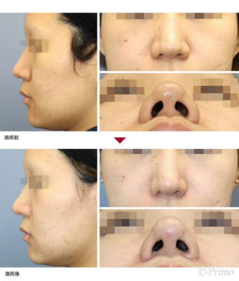 U 鼻尖縮小術（3D法）＋鼻翼縮小術（内側法＋外側法） 症例経過写真