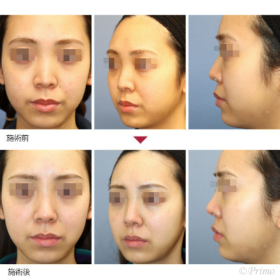 GR 他院鼻中隔延長修正術＋隆鼻術＋眉間プロテーゼ（特別注文プロテーゼ） 症例経過写真