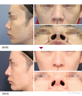 IW 鼻中隔延長術＋隆鼻術＋眉間プロテーゼ＋鼻翼縮小術（内側法＋外側法） 症例経過写真