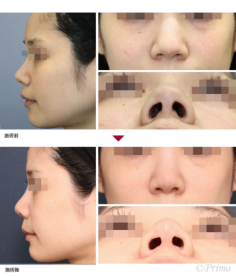 S 整鼻術＋鼻尖縮小術＋鼻翼縮小術（内側法） 症例経過写真