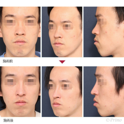 JG 鼻中隔延長術＋隆鼻術＋眉間プロテーゼ＋鼻翼縮小術（内側法＋外側法） 症例経過写真