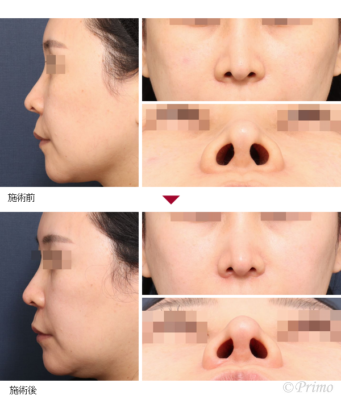 O 鼻翼縮小術（内側法＋外側法） 症例経過写真