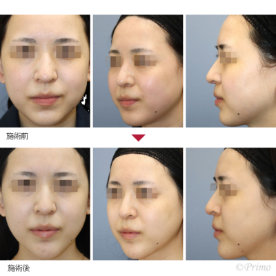 G 他院アゴプロテーゼ入れ替え術 症例経過写真