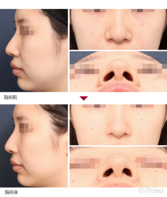 P 鼻翼縮小術（内側法＋外側法） 症例経過写真