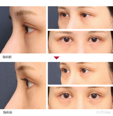 BC 下眼瞼拡大術＋下眼瞼脱脂術＋目頭脂肪注入 症例経過写真