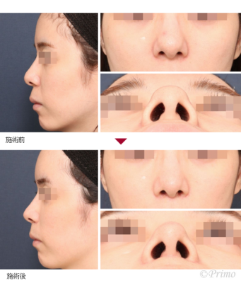 S 鼻尖縮小術（3D法） 症例経過写真