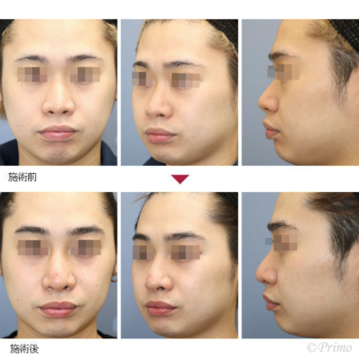 KB 鼻中隔延長術＋隆鼻術＋眉間プロテーゼ 症例経過写真
