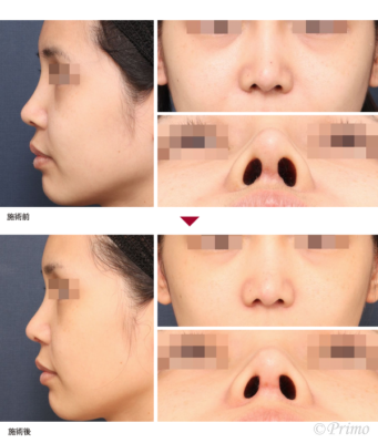 BA 鼻翼縮小術（内側法）＋鼻柱形成術＋他院鼻プロテーゼ入れ替え術＋眉間プロテーゼ 症例経過写真