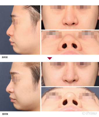 BB 鼻翼縮小術（外側法）＋鼻尖縮小術＋鼻翼挙上術＋自院鼻プロテーゼ入れ替え術＋眉間プロテーゼ 症例経過写真