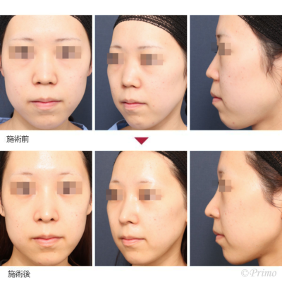 KO 鼻中隔延長術（肋軟骨＋耳介軟骨）＋隆鼻術＋眉間プロテーゼ（特注）＋鼻翼基部プロテーゼ 症例経過写真