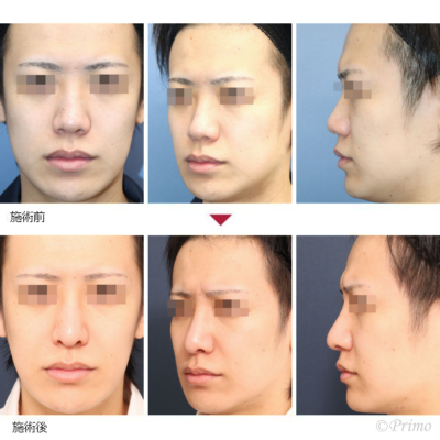 BD 鼻中隔延長術＋隆鼻術＋眉間プロテーゼ＋鼻翼縮小術（外側法）＋鼻翼基部プロテーゼ 症例経過写真
