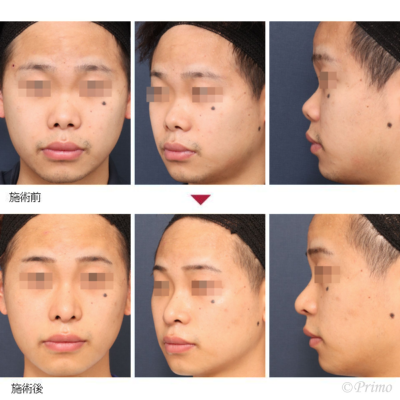 JN 鼻中隔延長術＋隆鼻術＋眉間プロテーゼ 症例経過写真