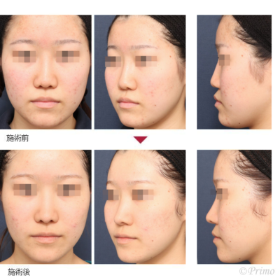KU 鼻中隔延長術＋他院鼻プロテーゼ加工術 症例経過写真