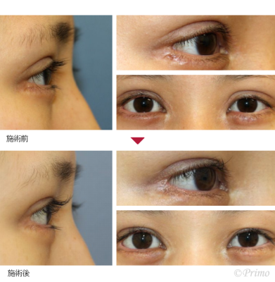 BA 二重修正術+右目尻切開修正術 症例経過写真