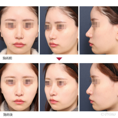 F 鼻翼挙上術 症例経過写真