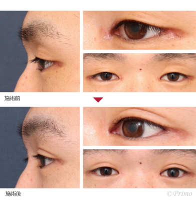 BK 他院目尻切開修正術 症例経過写真