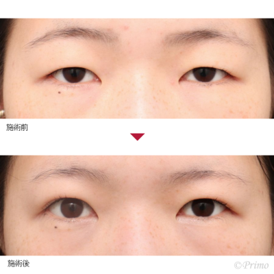 DZ 二重埋没法6点固定+上眼瞼脱脂術 症例経過写真