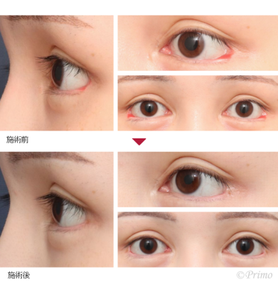 BL 他院目尻切開修正術 症例経過写真