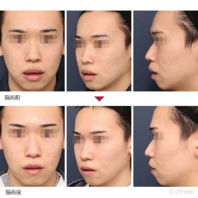 A 上下口唇縮小術 症例経過写真