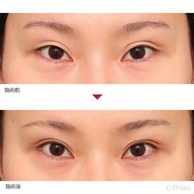 DX 全切開＋上眼瞼脱脂術 症例経過写真