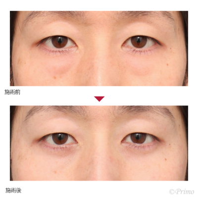 W 下眼瞼脱脂術 症例経過写真