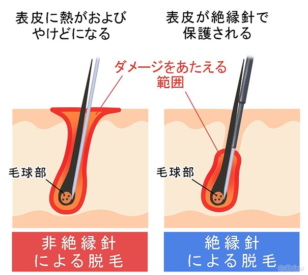 絶縁針脱毛 | プリモ麻布十番クリニック