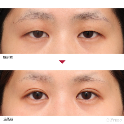 EH 二重埋没法6点固定 症例経過写真