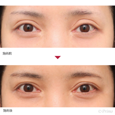 BW 二重修正術（重瞼修正切開術）＋左目眼瞼下垂手術 症例経過写真