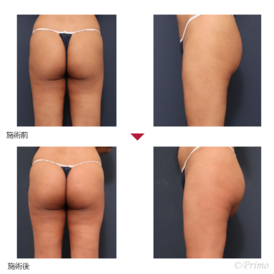 U お尻の脂肪注入 症例経過写真