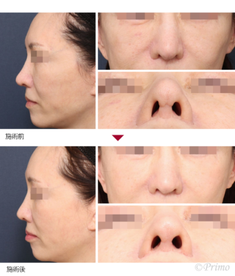 H 鼻尖形成術＋鼻翼修正術（小鼻修正術） 症例経過写真