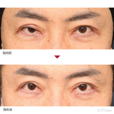 CW 他院右眼瞼下垂修正術 症例経過写真
