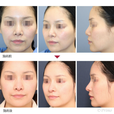 J 頬部・こめかみ脂肪注入+鼻中隔延長術 症例経過写真
