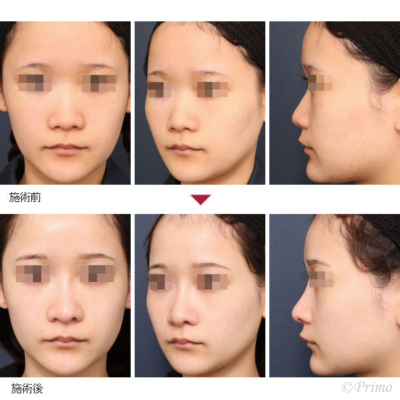 MG 鼻中隔延長術＋隆鼻術＋眉間プロテーゼ（特別注文プロテーゼ）＋鼻翼縮小術（内側法）＋鼻尖形成術 症例経過写真