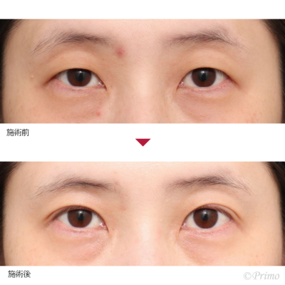 EA 全切開+上眼瞼脱脂術 症例経過写真
