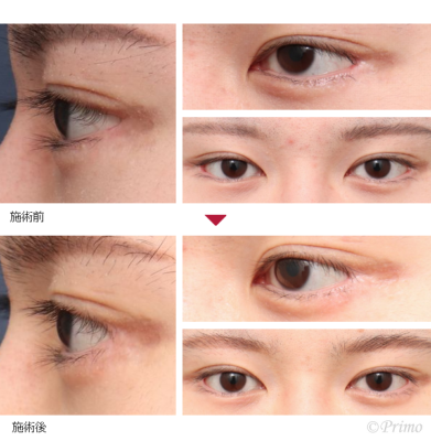 BM 他院目尻切開修正術 症例経過写真