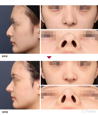 BG 鼻中隔延長術+隆鼻術+整鼻術+鼻尖形成術+鼻尖縮小術 症例経過写真