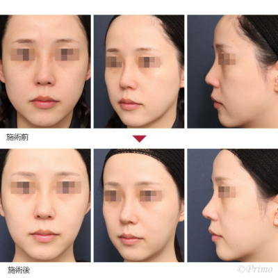 MH 鼻中隔延長術＋鼻尖形成術＋他院鼻プロテーゼ加工術 症例経過写真