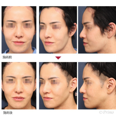 Q 下顎角形成術 症例経過写真