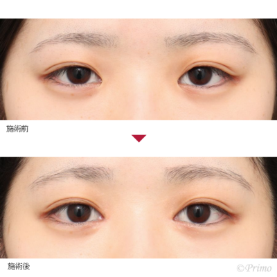 BQ 目頭切開 症例経過写真