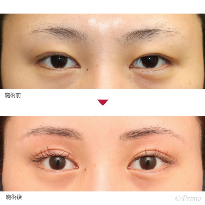 T 上眼瞼リフト 症例経過写真