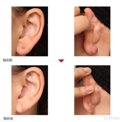B 左耳垂ケロイド修正術 症例経過写真