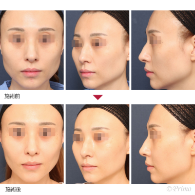 BA コグリフト+頬部脂肪注入 症例経過写真