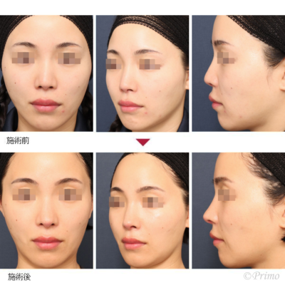 MM 鼻中隔延長術＋鼻尖形成術＋他院鼻プロテーゼ入れ替え術＋眉間プロテーゼ（特別注文プロテーゼ） 症例経過写真