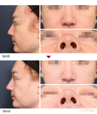 Y 鼻尖縮小術（3D法） 症例経過写真