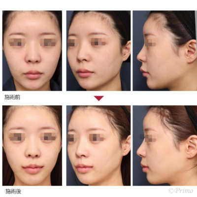 R 下顎角形成術 症例経過写真